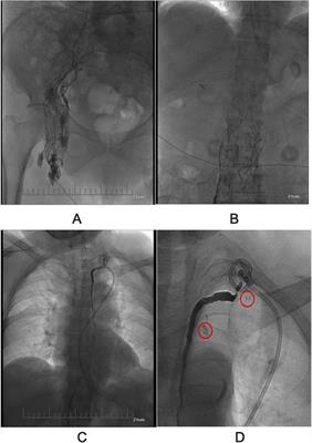 Intranodal lymphangiography combined with foam sclerotherapy embolization of thoracic duct in the treatment of postoperative chylous leakage for thyroid carcinoma: a case report and review